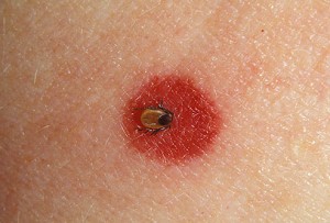 Tick Bites: Symptoms and Treatments - Healthline